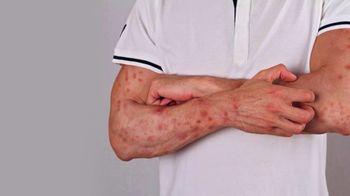 Center for Dermatology Clinical Research TV Spot, 'Prurigo Nodularis Research Study' - Thumbnail 1